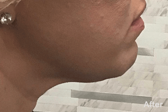 Morpheus8 in Scottsdale - Med Spa Scottsdale