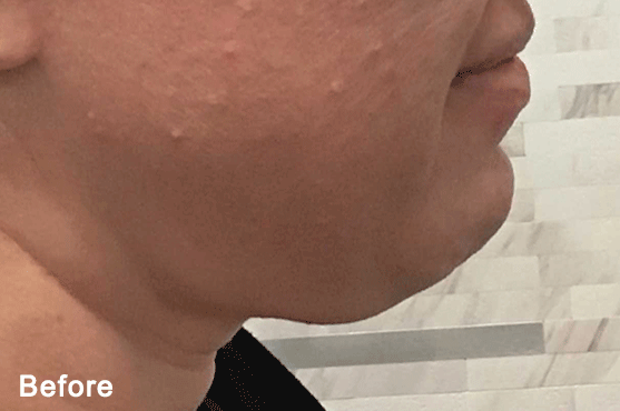 Morpheus8 in Scottsdale - Med Spa Scottsdale