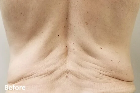 Morpheus8 in Scottsdale - Med Spa Scottsdale