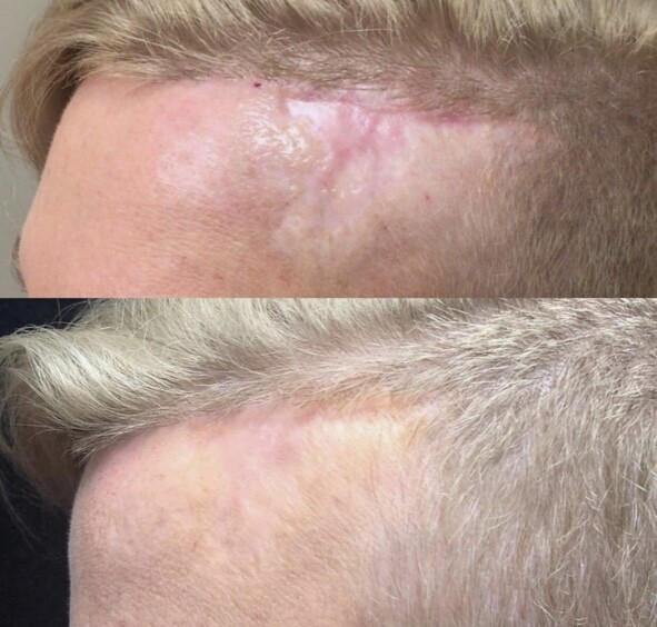 Morpheus8 in Scottsdale - Med Spa Scottsdale