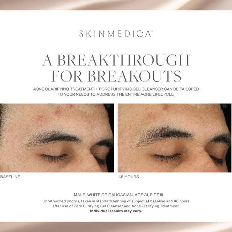 Sm 2408 Acne Ba Front 1 Jpg 370x370@2x - Med Spa Scottsdale