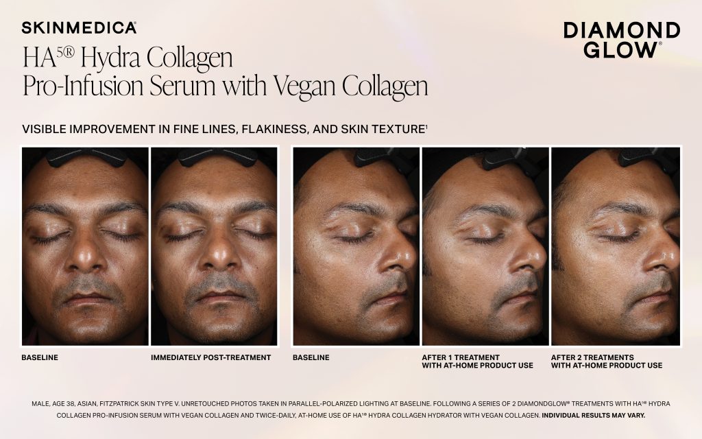 Dg Ha5 Hc Pro Infusion Serum Immediate 1tx 2tx Fitzv Scaled - Med Spa Scottsdale