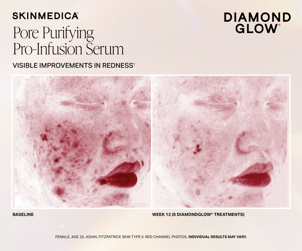 Dg Pore Purifying Pro Infusion Serum 6tx Fitzii Scaled - Med Spa Scottsdale