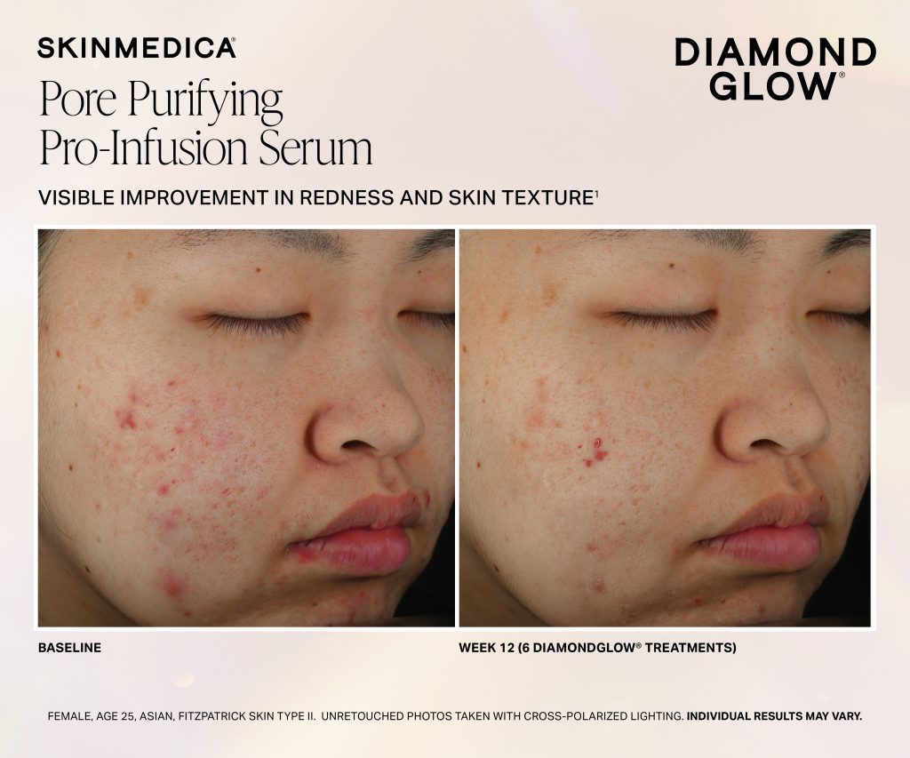 Dg Pore Purifying Pro Infusion Serum Week 12 Fitzii Scaled - Med Spa Scottsdale