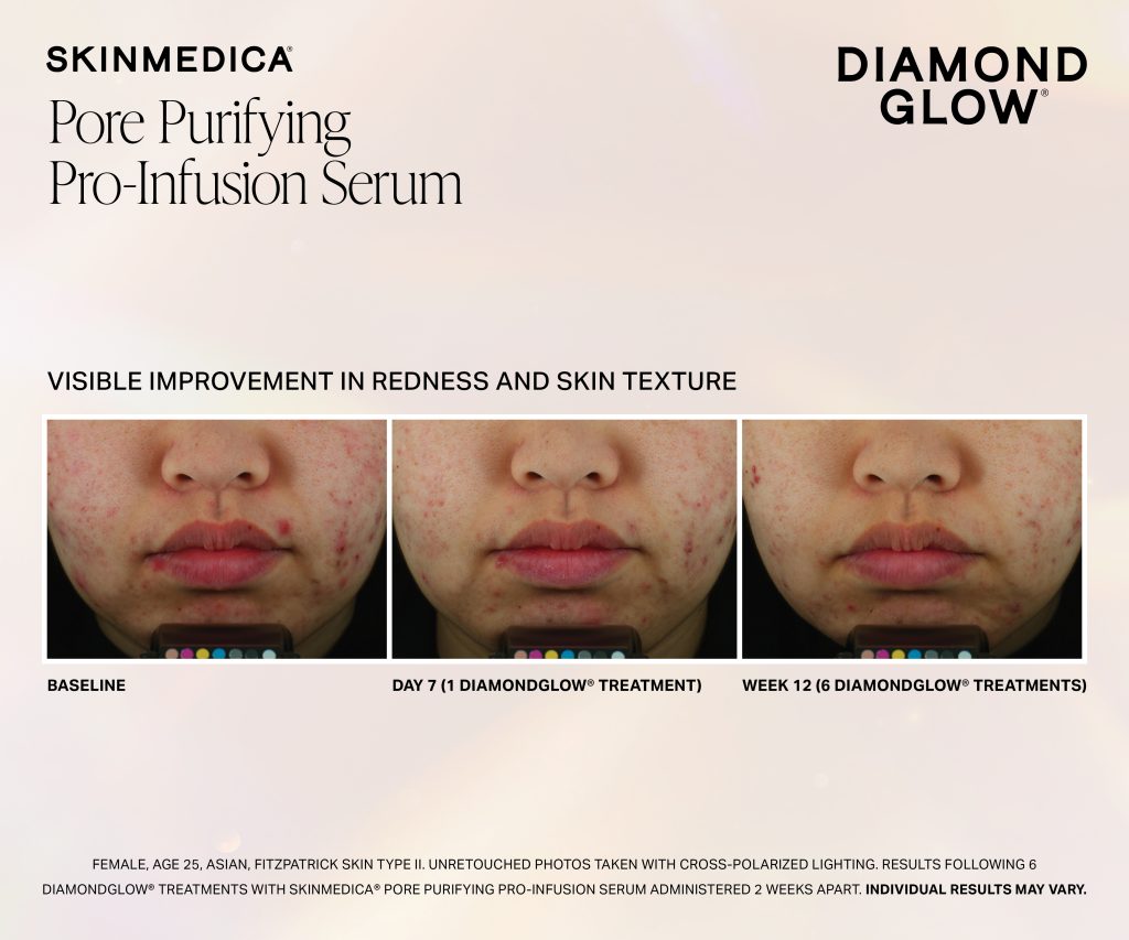 Dg Pore Purifying Pro Infusion Serum Week 1 Week 12 Fitzii Scaled - Med Spa Scottsdale