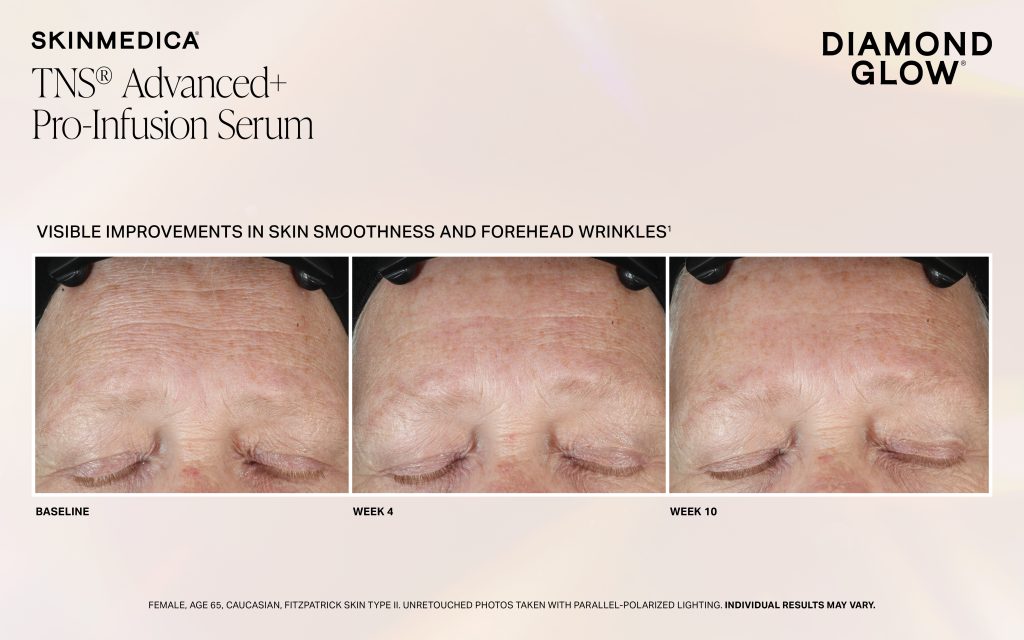 Dg Tns Pro Infusion Serum Week 4 Week 8 Fitzii Scaled - Med Spa Scottsdale