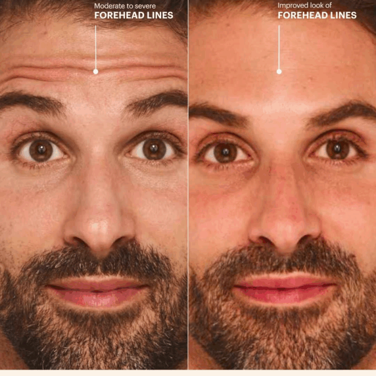Botox Cosmetic Ba Stephen Social Post Video Png 370x370@2x - Med Spa Scottsdale