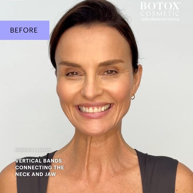 Botox Cosmetic Before And After Ana Social Post Video Jpeg 370x370@2x - Med Spa Scottsdale