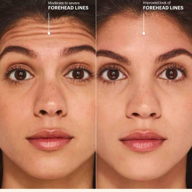 Botox Cosmetic Side By Side Ba Social Post Nicole Jpg 370x370@2x - Med Spa Scottsdale