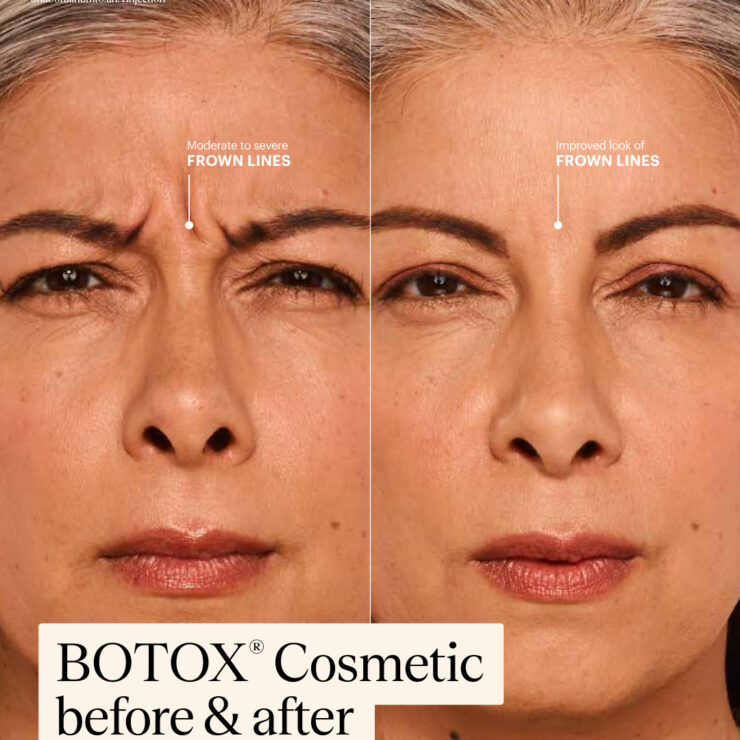 Botox Cosmetic Side By Side Before After Delfina Social Post Video Jpg 370x370@2x - Med Spa Scottsdale